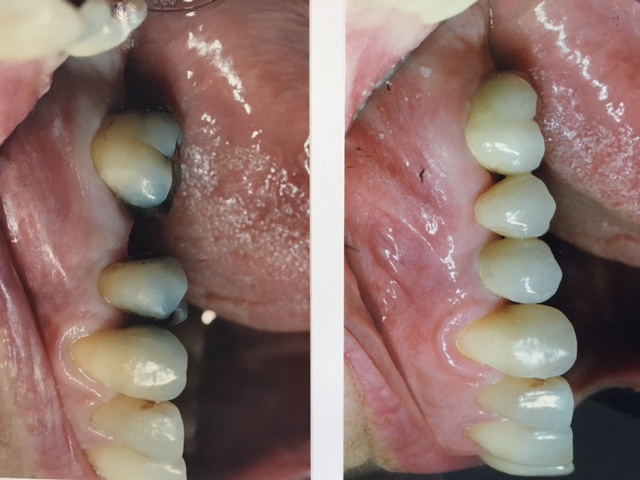 Close missing tooth with bridge