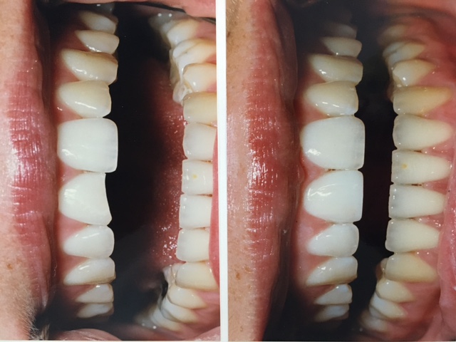 Teeth Before and After